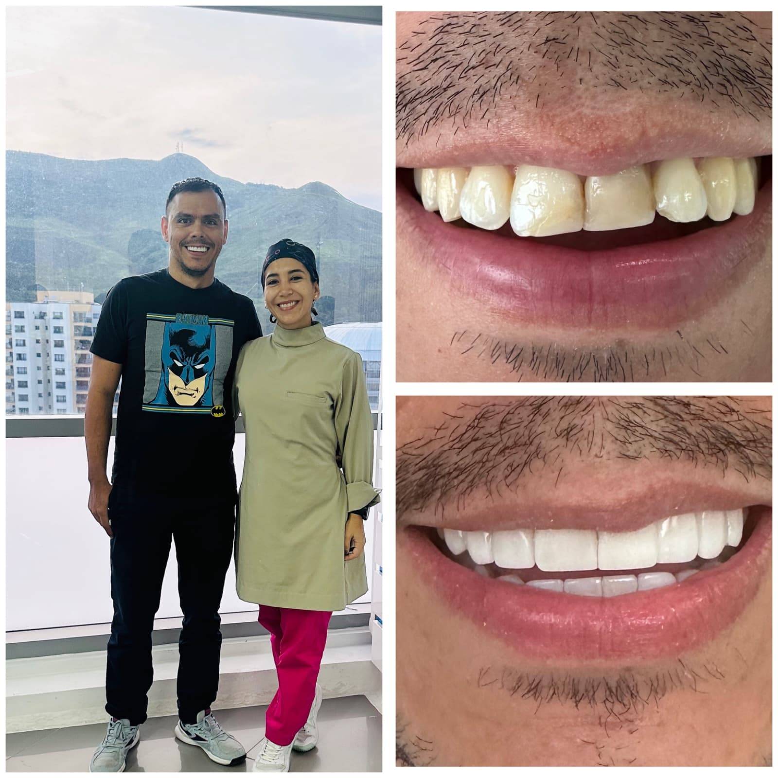 diseño de sonrisa Cali