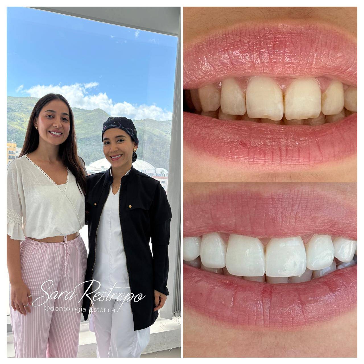 ¿Cuánto dura un diseño de sonrisa en Colombia?